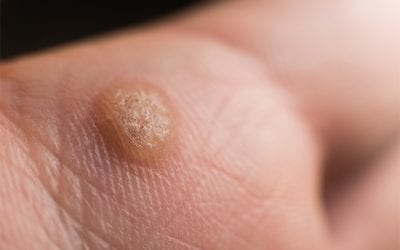 Verrucas – to treat or not to treat?